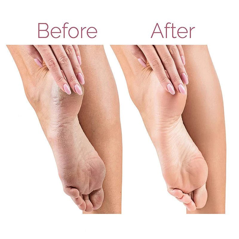 Electric Pedicure Foot File Callus Remover - ekhonibuy